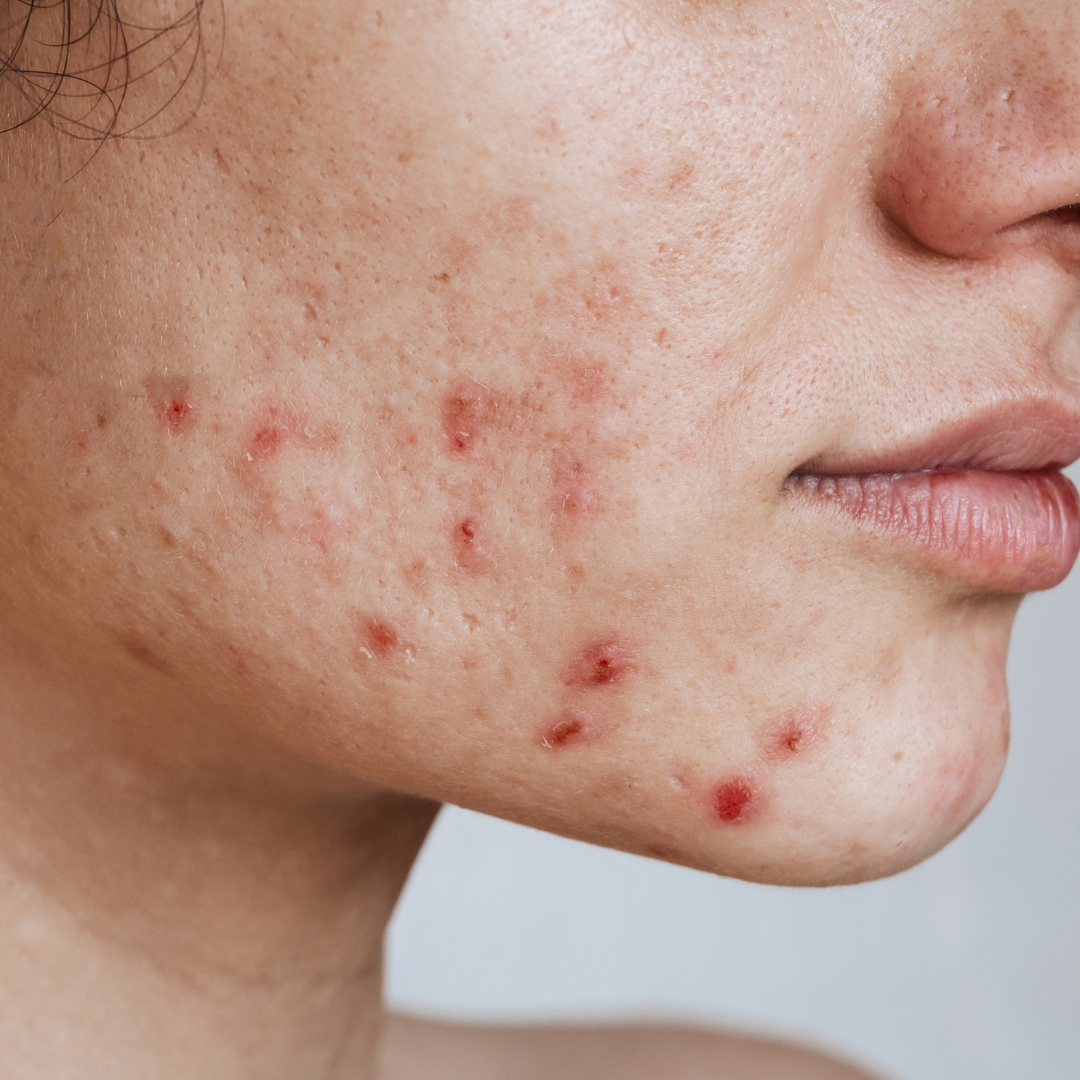 Skin Purging vs. Acne: How to Tell the Difference and What to Do